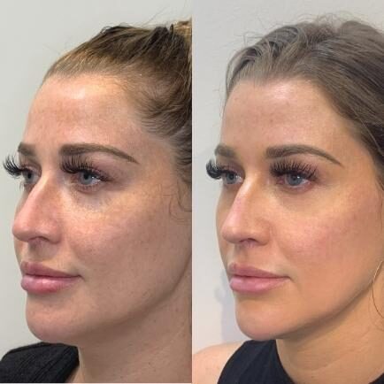 Woman's face before and after receiving cheek filler, chin filler and IPL Photofacial treatments at Viva Day Spa + Med Spa in Austin, Texas.