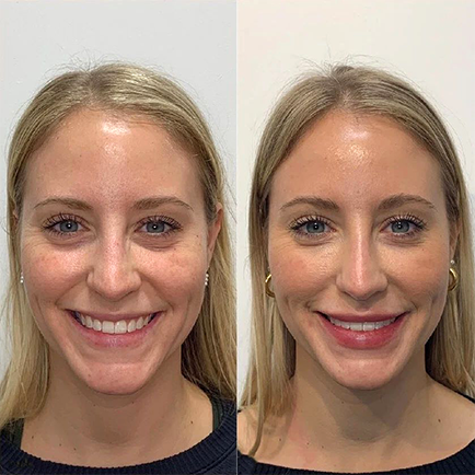 Woman's face before and after lip filler, tear trough filler, and a liquid rhinoplasty in Austin at Viva Day Spa + Med Spa.