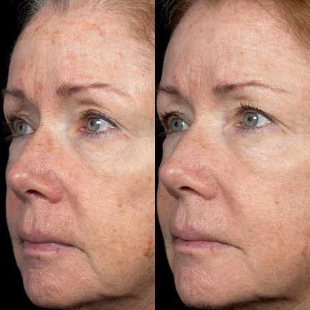 Before and after close-up of an older woman's face showing improvement to pigmentation after receiving two Fraxel Dual laser resurfacing treatments.