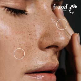 Close-up of a woman's face with freckles and sun damage before receiving a Fraxel laser resurfacing treatment.