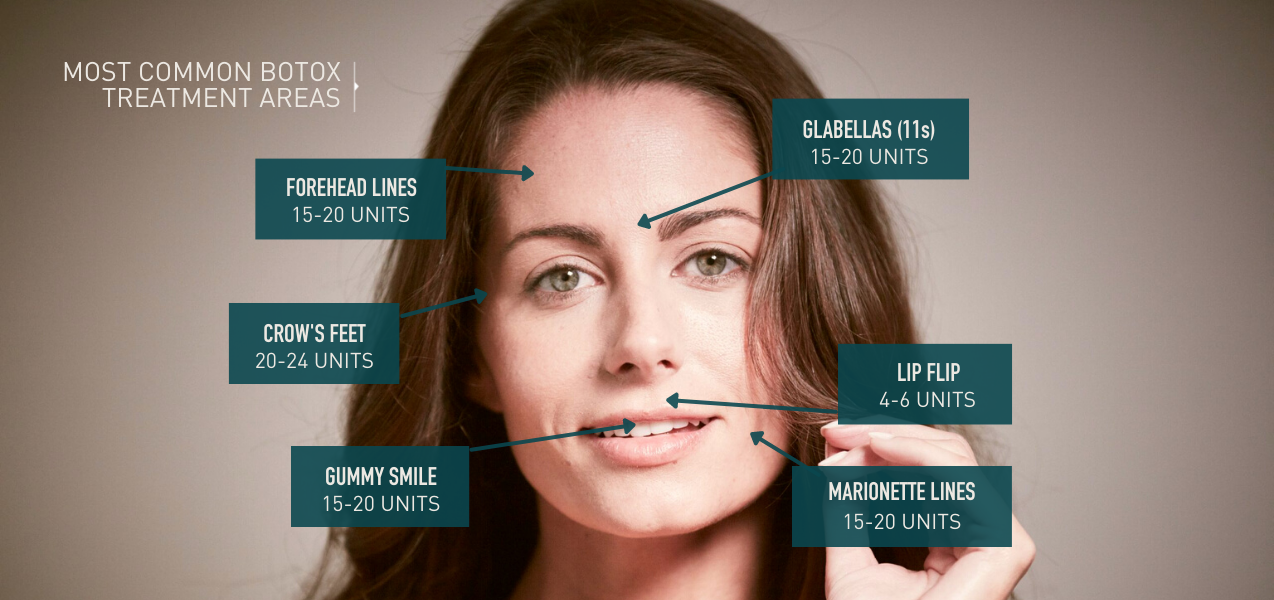 Viva Day Spa_Botox Treatment Areas