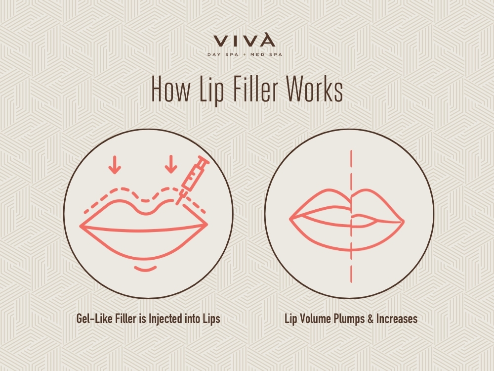 How Lip Filler Works: shows two Viva-branded illustrations that show 1. Gel-like filler is injected into lips and 2. Lip volume plumps & increases